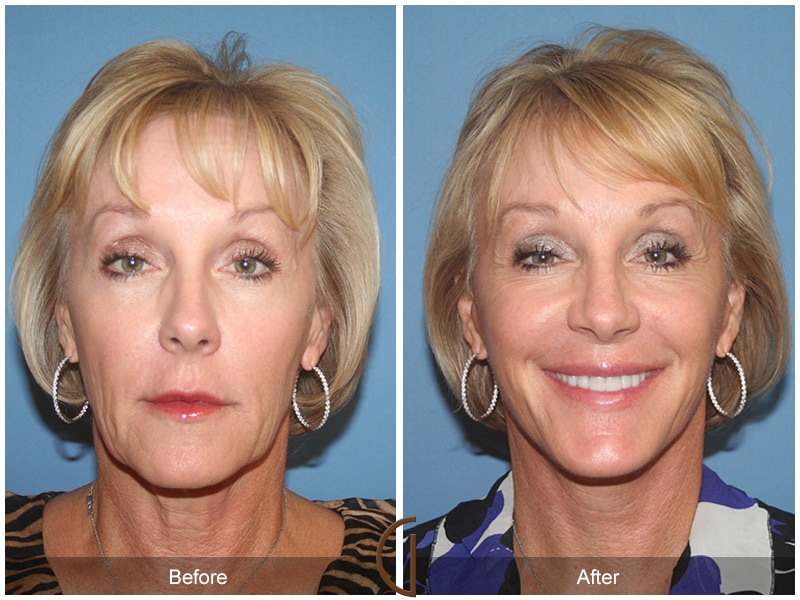 Plastic Cosmetic Surgery Near Me Long Beach California