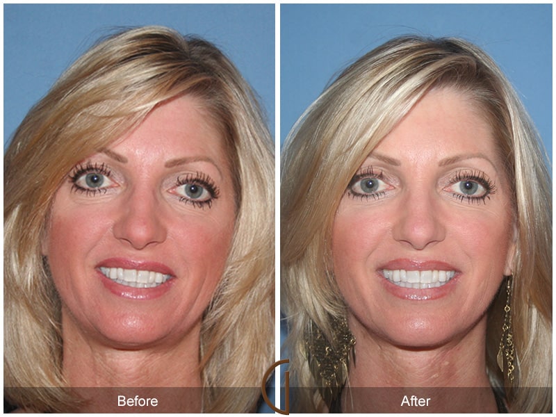 Plastic Cosmetic Surgery Near Me Long Beach California