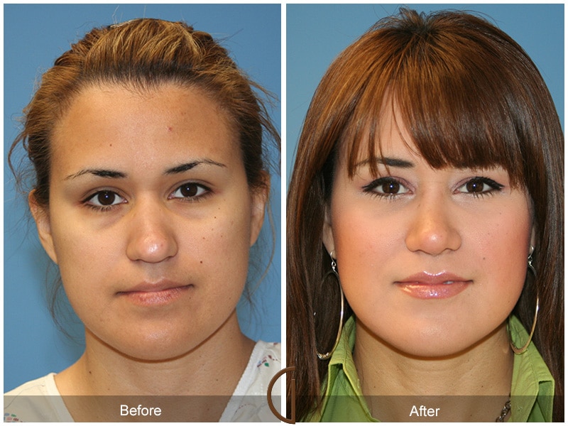 Plastic Cosmetic Surgery Near Me Long Beach California