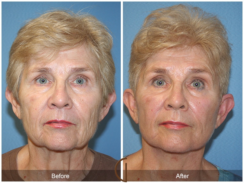 Plastic Cosmetic Surgery Near Me Long Beach California