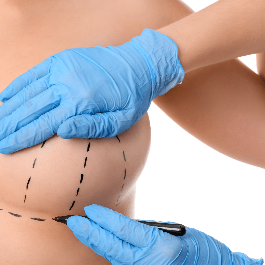 A Closer Look at Breast Augmentation: Choices and Outcomes