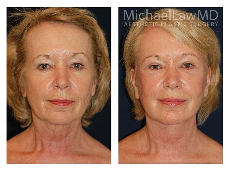 Plastic Cosmetic Surgery Near Me Raleigh North Carolina Plastic Cosmetic Surgery Near Me Raleigh North Carolina