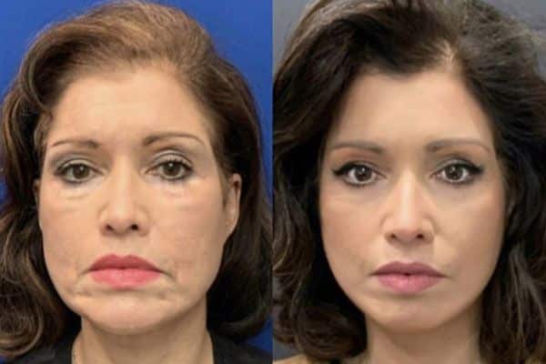 Mommy Makeovers: Restoring Post-Pregnancy Confidence