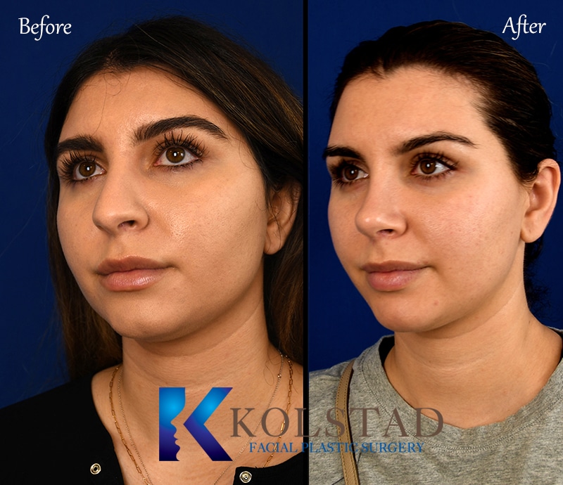 Plastic Cosmetic Surgery Near Me San Diego California