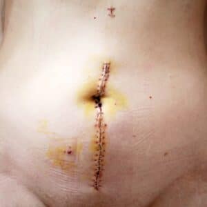 Photo Surgical scars