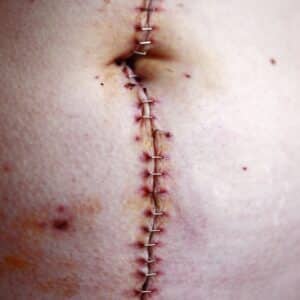 Photo Replantation Surgery Procedure