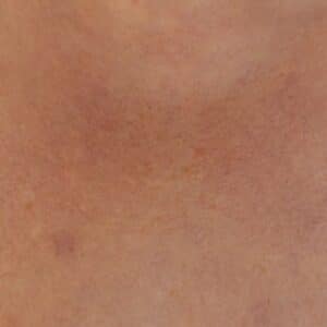 Photo Fractional Laser Resurfacing Procedure