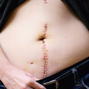 Photo "What Hurts More Lipo or Tummy Tuck?"