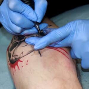 Photo Scar Revision Laser Therapy Procedure