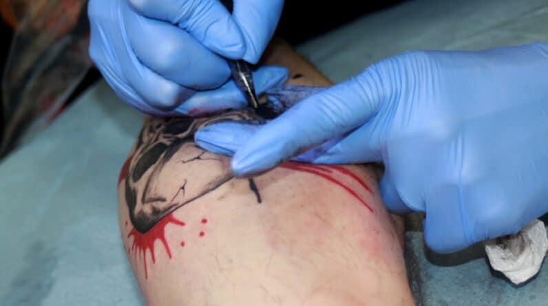 Photo Scar Revision Laser Therapy Procedure