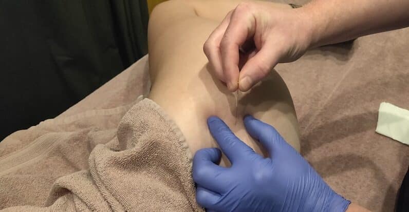 Photo Spider Vein Treatment Sclerotherapy Procedure