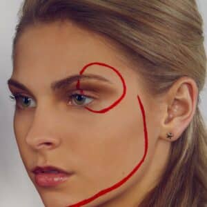 Photo Thread Lift Procedure