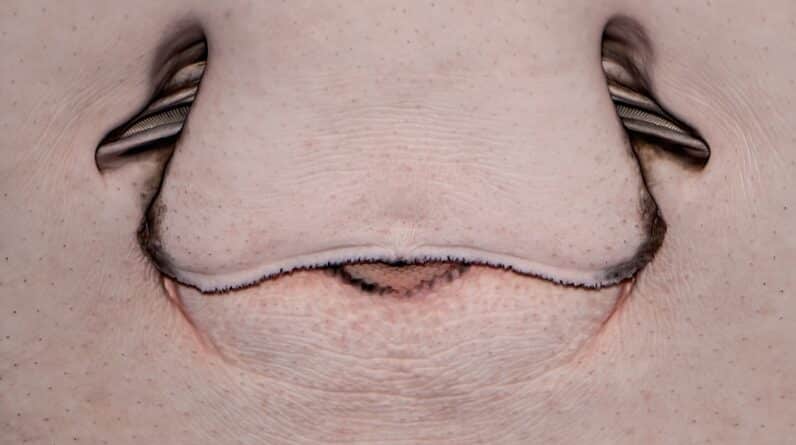 Photo Rhinoplasty Surgeon