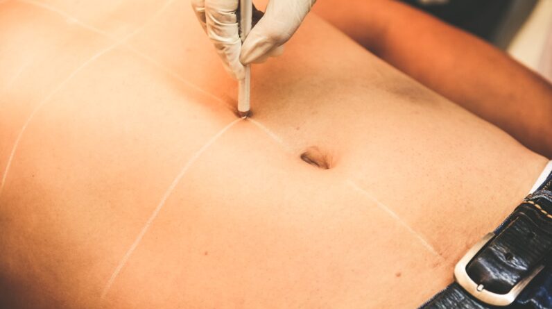 Photo Liposuction Specialist