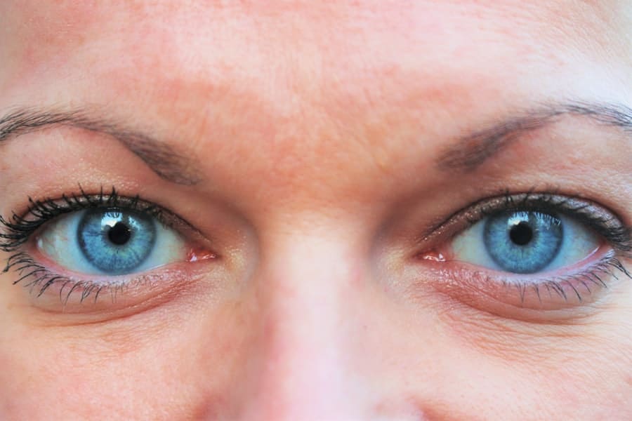 Photo Eyelid Lift Surgery