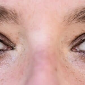 Photo Eyelid Surgery